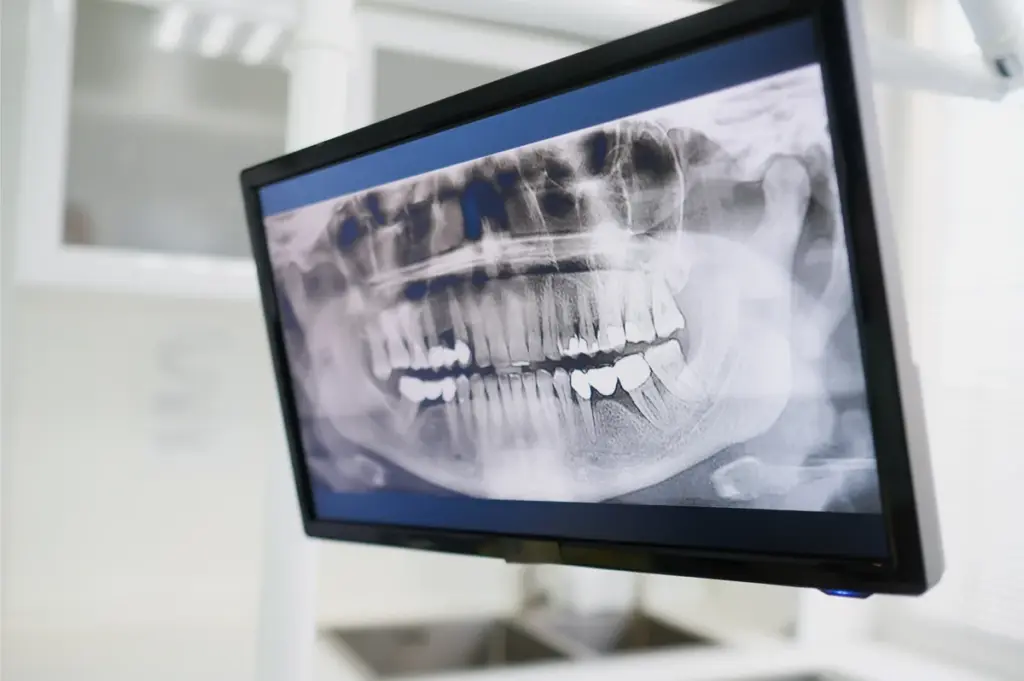 A panoramic dental X-ray displayed on a treatment room monitor